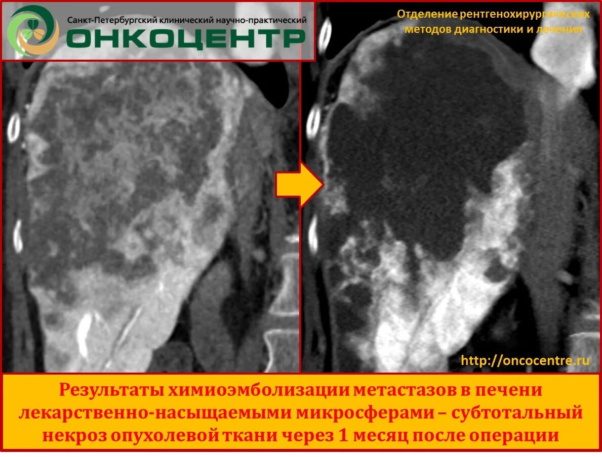 Продолжительность жизни при метастазах. Химиоэмболизация метастазов в печени. Как выглядит человек с метастазами.