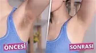 Как избавиться от подмышки