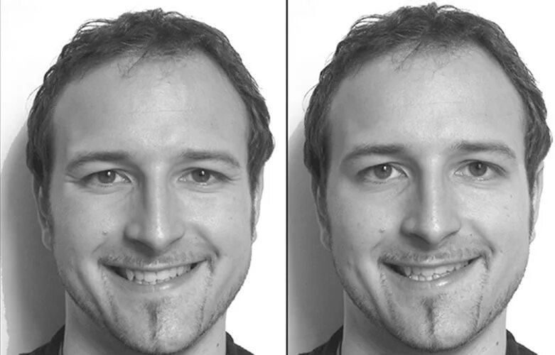 Дюшен гийом дюшен. Дюшеновская улыбка. Улыбка дюшена. Дюшеновская улыбка. Улыбка дюшенна.