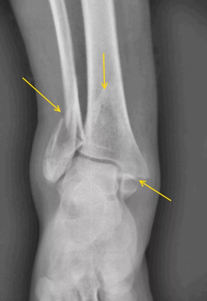 Трещина в коленной. Перелом внешней лодыжки рентген. Перелом лодыжки рентген. Перелом наружной лодыжки Рент. Супинационный перелом лодыжки рентген.