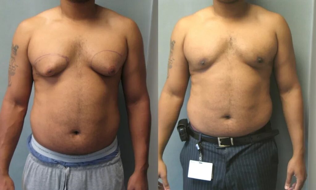 сыроедческая гинекомастия. гипогонадизм гинекомастия. гинекомастия у мужчин операция. гинекомастия у мужчин операция. сыроедческая гинекомастия.