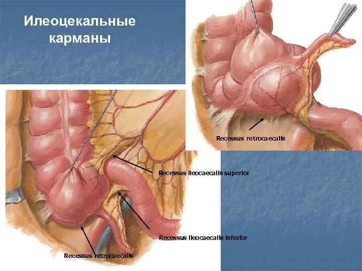 Слепая кишка стенки. Верхний подвздошно слепокишечный карман. Верхнее подвздошно-слепокишечное углубление анатомия. Илеоцекальная складка брюшины. Верхний илеоцекальный карман.