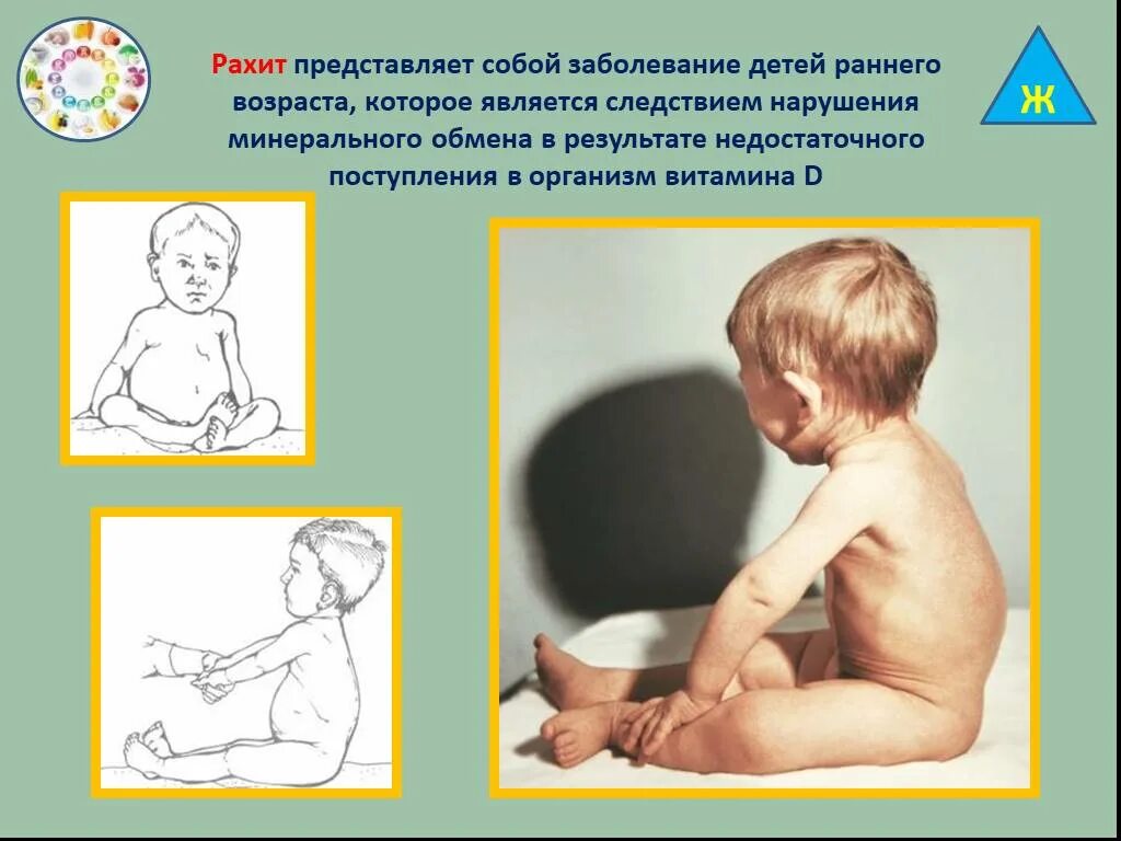 Фосфоропенический рахит. Рахит у детей раннего возраста. Рахит и рахитоподобные заболевания у детей раннего возраста. Рахит в 6