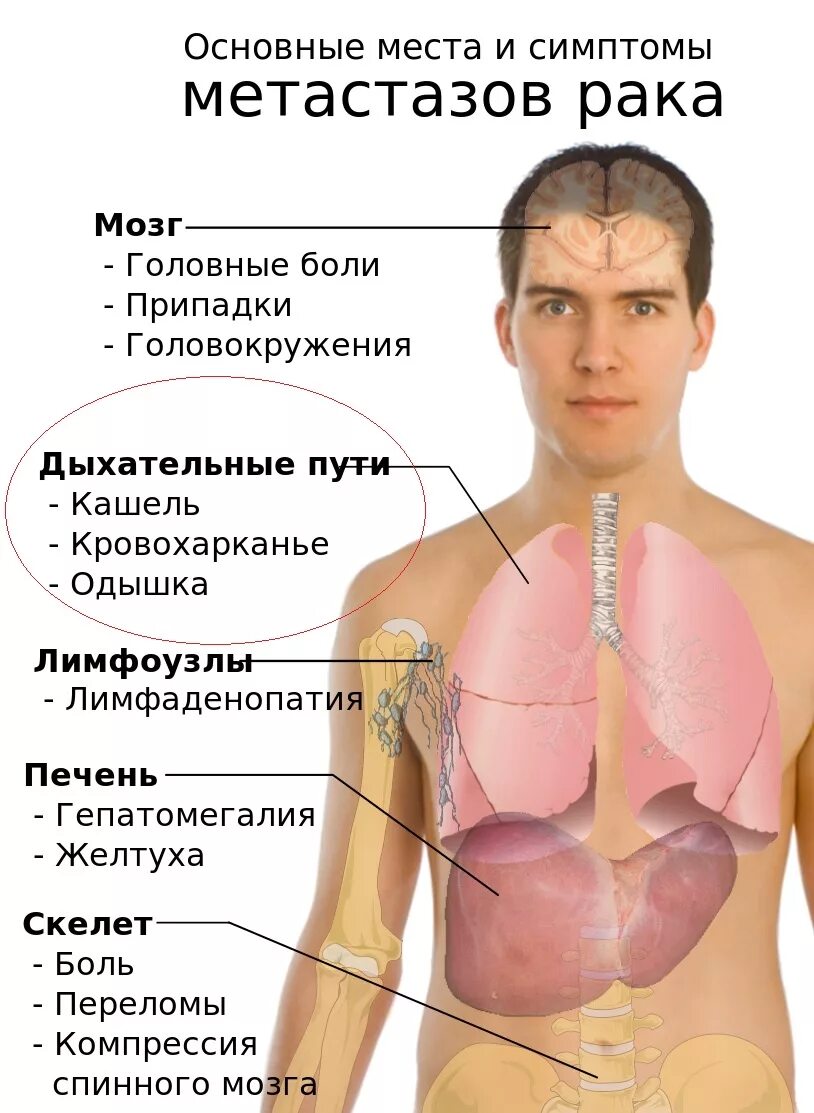 Онкологическое заболевание 4 стадии