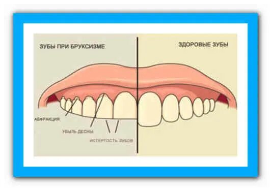 Чешутся зубы у взрослого. Чешутся зубы у взрослого человека. Чешутся зубы у взрослого человека. Десквамативный гингивит. Чешутся зубы у взрослого человека.