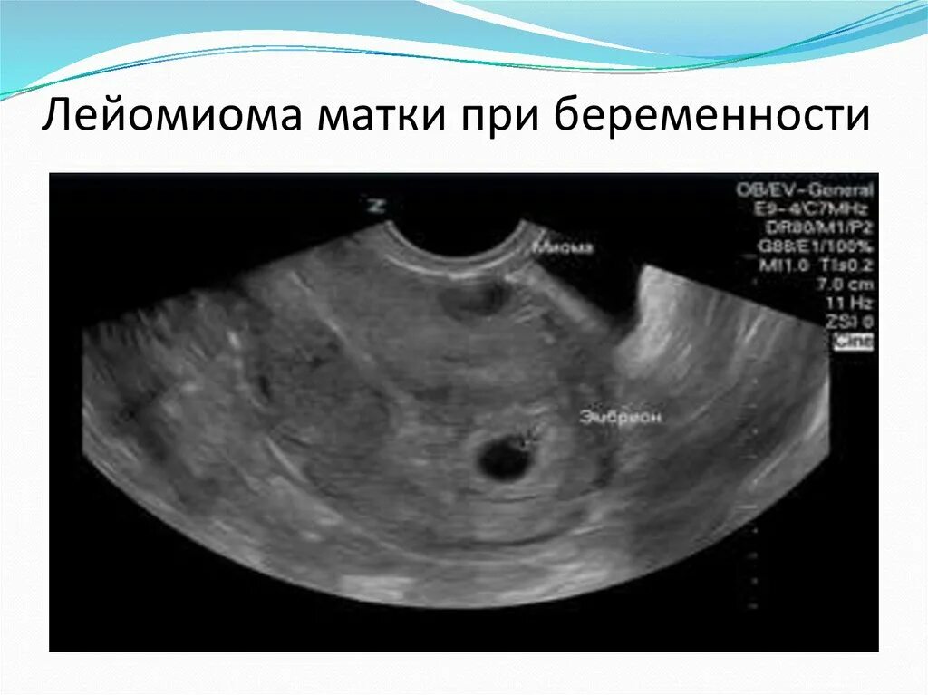 Шеечный миоматозный узел на УЗИ. Шеечная миома матки УЗИ. Миома в полости матки УЗИ. Миома матки и беременность УЗИ. Матка на 1 неделе беременности