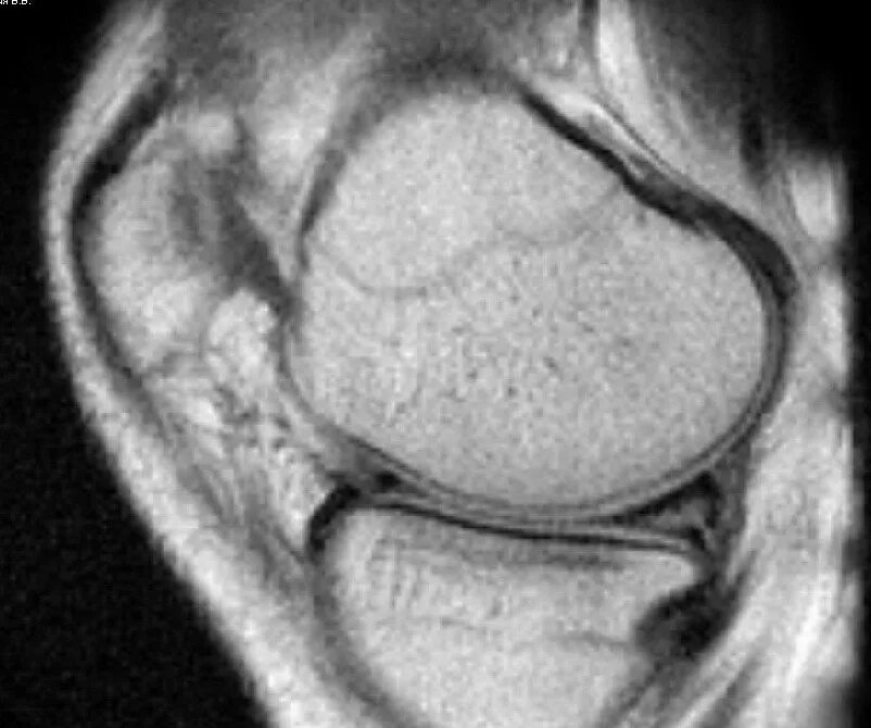 Разрыв мениска мрт. Разрыв внутреннего медиального мениска мрт. Разрыв заднего рога медиального Stoller III. Повреждение мениска на мрт.