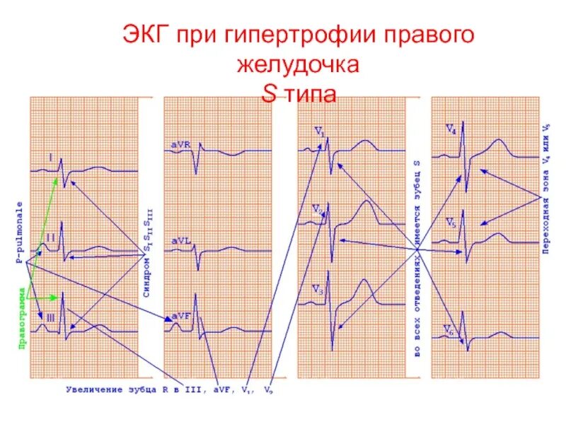 Гипертрофия левого и правого желудочка сердца. S тип гипертрофии правого желудочка на экг. гипертрофия правого желудочка на экг. экг в 12 отведениях гипертрофия правого желудочка. типы гипертрофии правого желудочка на экг.