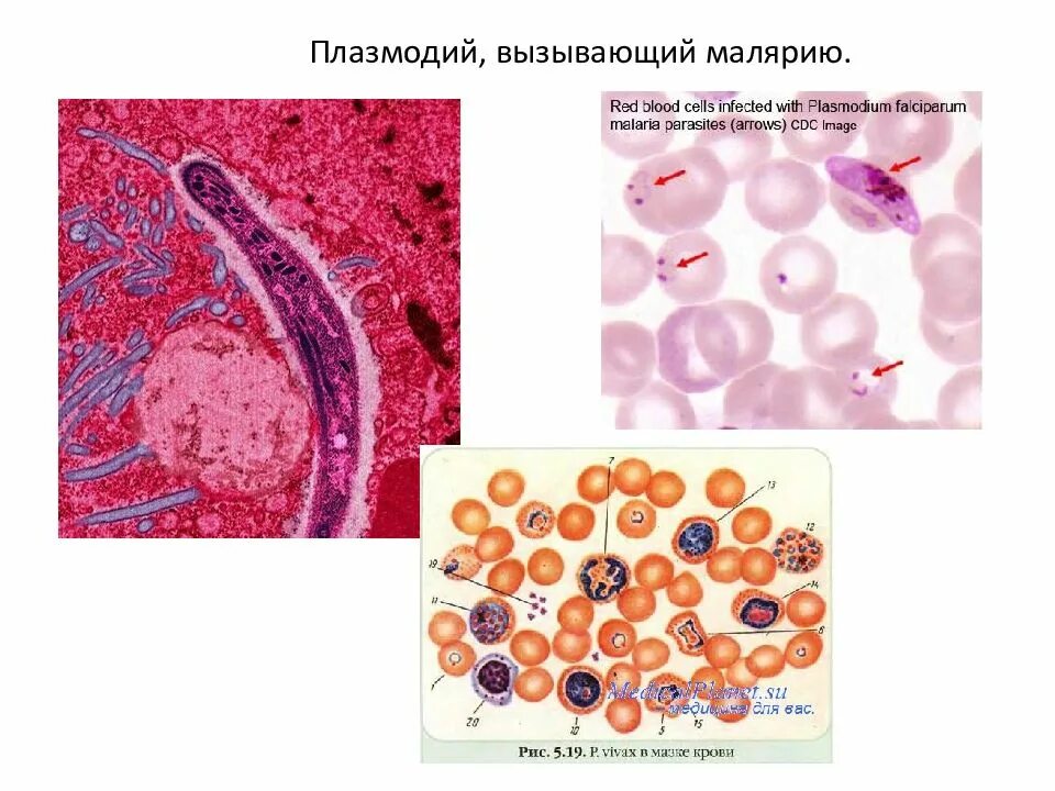 Малярия клетки. Малярийный плазмодий. Малярийный плазмодий возбудитель. Споровики малярийный плазмодий. Эритроциты с малярийными плазмодиями внутри.
