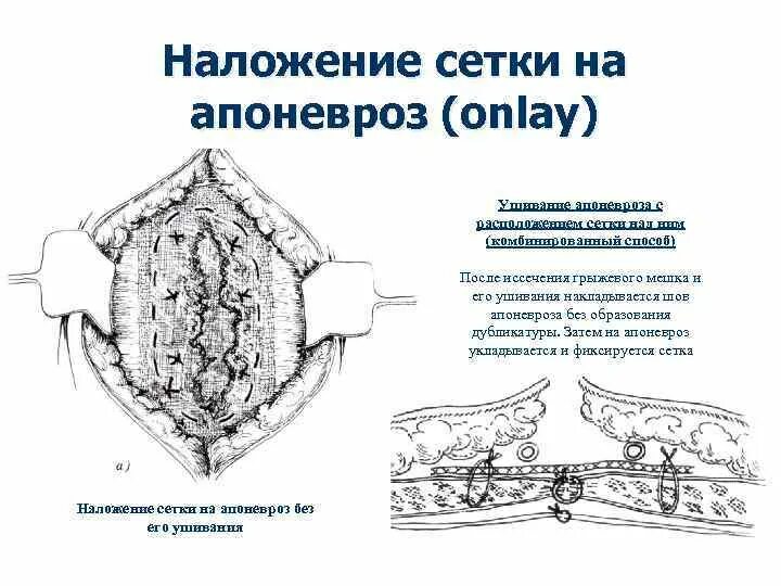 Брюшная стенка после операции. Вентральная грыжа после операции. Аллопластика вентральной грыжи живота. Дефект апоневроза передней брюшной стенки. Вентральные грыжи пластика грыжевых ворот.