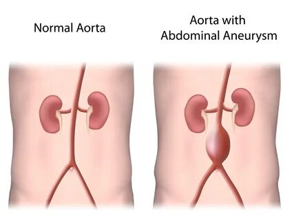 Abdominal aortic aneurysm