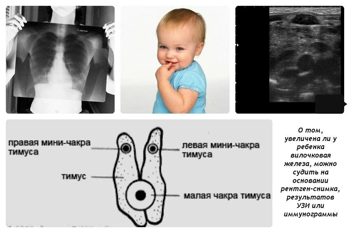 Вилочковая железа на рентгене у детей. Тимус на рентгене у детей. Тимус на рентгене у детей до года. Тимус 2 степени у ребенка.