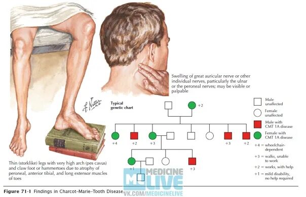 Генетическое заболевание Шарко Мари тута. Атрофия мышц Шарко Мари. Наследственная моторно-сенсорная невропатия Шарко-Мари-тута. Синдром шарко