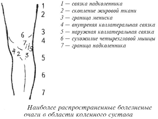 Методика массажа коленного сустава. Точечный массаж колена. Точечный массаж при болях в коленных суставах. Точки для массажа -коленного сустава при артрозе. Можно делать массаж при артрозе