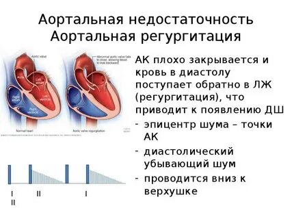 Регургитация