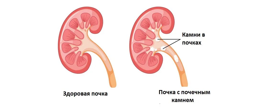 За сколько проходят почки. Пиелонефрит камни в почках. Пиелонефрит и мочекаменная болезнь. Пиелонефрит при мочекаменной болезни.