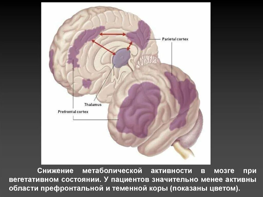 Вегетативная состояние мозга. Мозг при вегетативном состоянии. Персистирующее вегетативное состояние. Персистирующие вегетативные состояния.