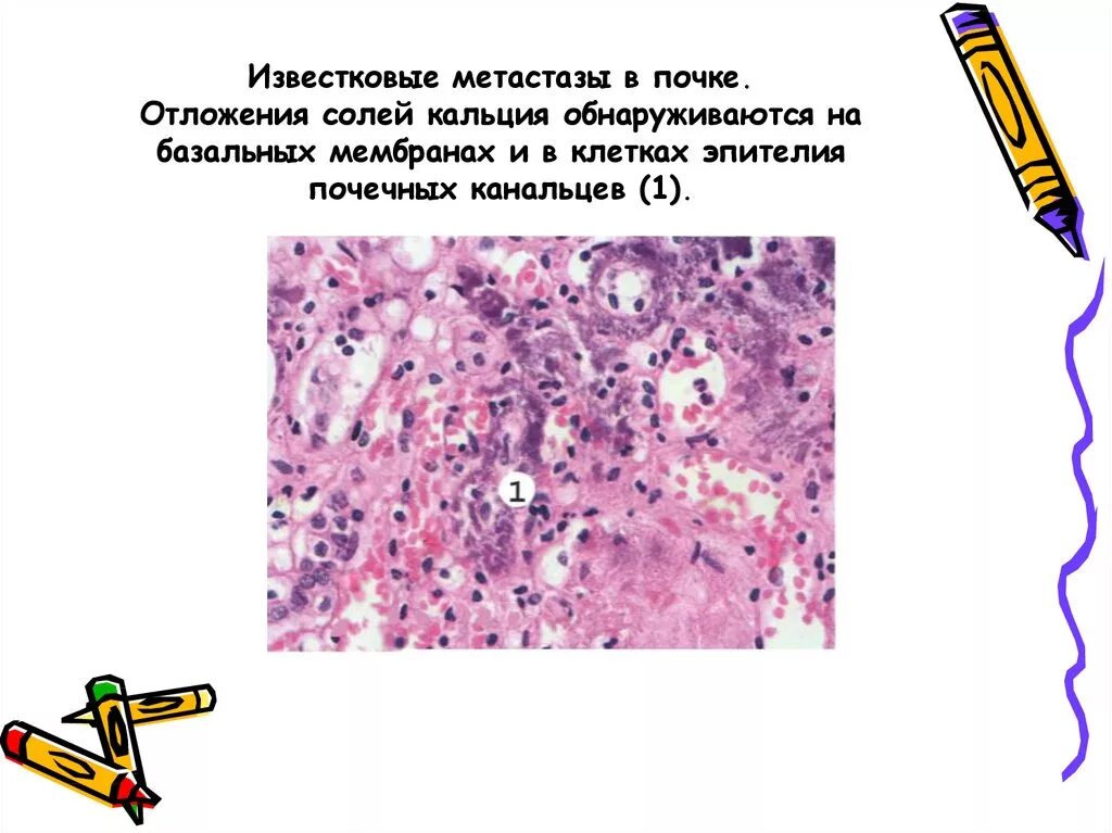 Отложение кальция. Известковые метастазы в почке микропрепарат. отложение солей кальция в почке микропрепарат. известковые метастазы в почке микропрепарат описание. отложение извести в миокарде.
