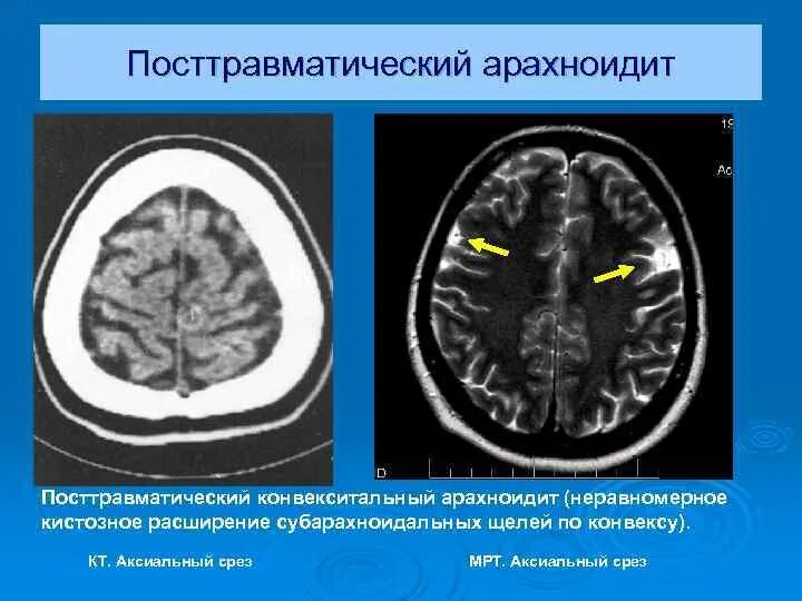 Умеренно расширение конвекситальных пространств