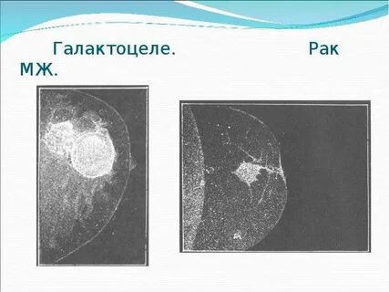 Рак ореола
