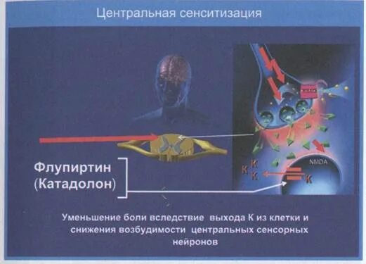 Повторяющиеся эпизоды центральной сенситизации