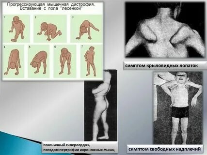 Генетическая мышечная дистрофия