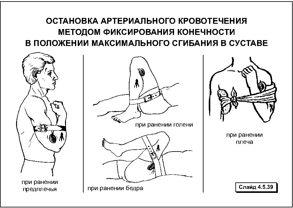 Методика остановки артериального кровотечения. Остановка артериального кровотечения алгоритм. Остановка артериального кровотечения из конечностей. Остановка крови при артериальном кровотечении. Как остановить кровотечение конечностей