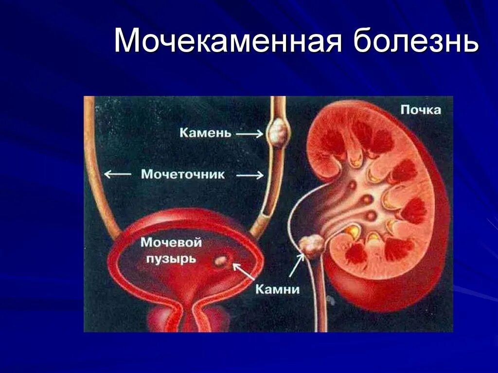 Мочекаменная болезнь урология камни мочеточника. Мочекаменная болезнь (уролитиаз). Осложнения мочекаменной болезни. Мочекаменная и Почечнокаменная болезнь.