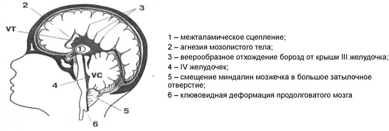 Мозжечок у плода норма. Эктопия миндалин мозжечка кт. Вклинение миндалин мозжечка в большое затылочное отверстие кт. Вклинение миндалин мозжечка кт. Аномалия развития головного мозга Арнольда Киари.