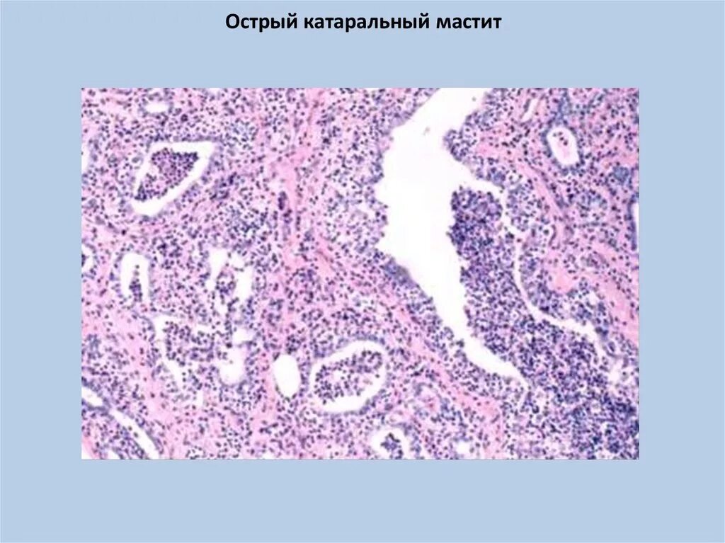 Острый мастит патанатомия. Патологическая анатомия мастита. Гнойный мастит патанатомия. Острый мастит микропрепарат. Острый гнойный мастит