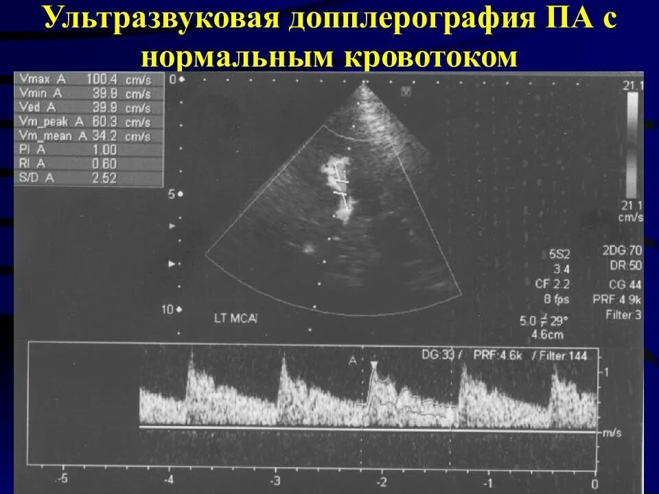 Нормальному кровообращению. Ультразвуковая спектральная допплерография. Ультразвуковая допплерография головного мозга. Ультразвуковая допплерография принцип метода. Допплерография сосудов головного мозга (УЗДГ).