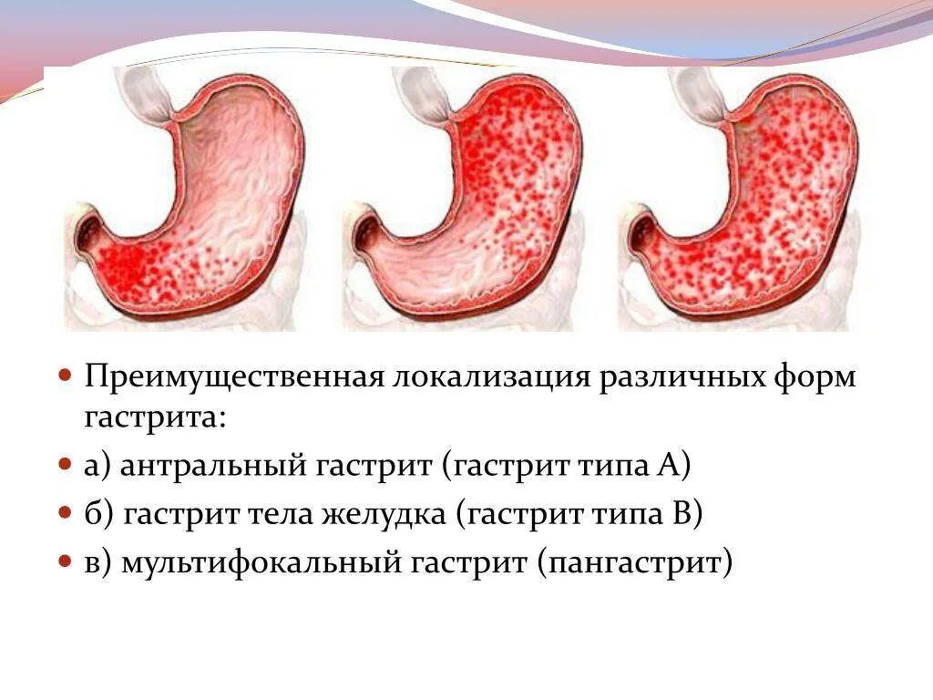 Ригидный антральный гастрит схема. Хронич антральный гастрит. Гастрит типа в локализуется в отделе желудка:. Хронический антральный гастрит (Тип б). Признаки атрофией слизистой оболочки