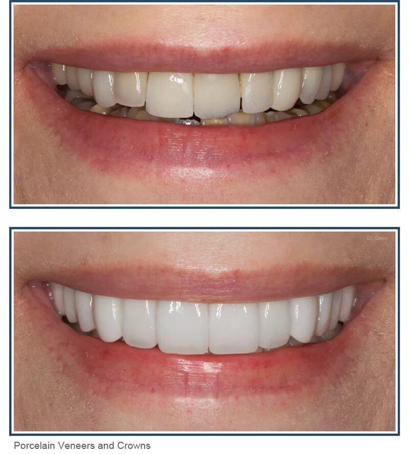 Керамические зубы до и после. Установленных до и после