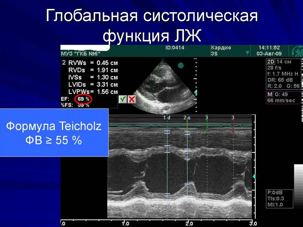 Глобальная сократимость левого желудочка. Оценка систолической функции лж. УЗИ сердца фракция выброса. Показатели систолической функции левого желудочка. Фракция выброса по Тейхольц.