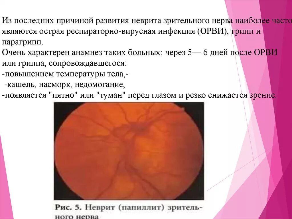 Этиология ретробульбарного неврита. Неврит зрительного нерва. Диск зрительного нерва при неврите. Зрительный неврит причины. Ретробульбарный неврит зрительного нерва офтальмология.