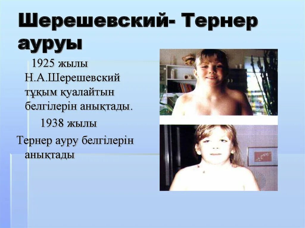 Хелиф синдром свайера. Определение синдрома шерешевского-тернера..