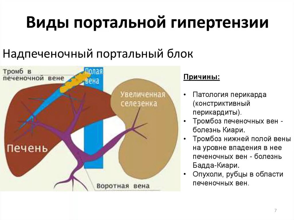 Внутрипеченочная портальная гипертензия. Портальная гипертензия подпеченочный блок. Этиология надпеченочной портальной гипертензии. Причины надпеченочной портальной гипертензии. Расширение селезеночной вены