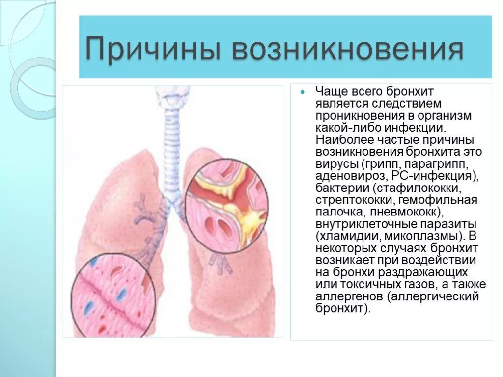 Бронхит это инфекционное заболевание. Инфекционные заболевания органов дыхания. Бронхит причины возникновения. Острые заболевания бронхов
