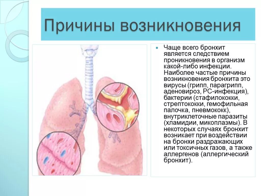 Бронхит причины возникновения. Острые заболевания бронхов. Заболевания дыхательной системы. Воспаление трахеи и бронхов.