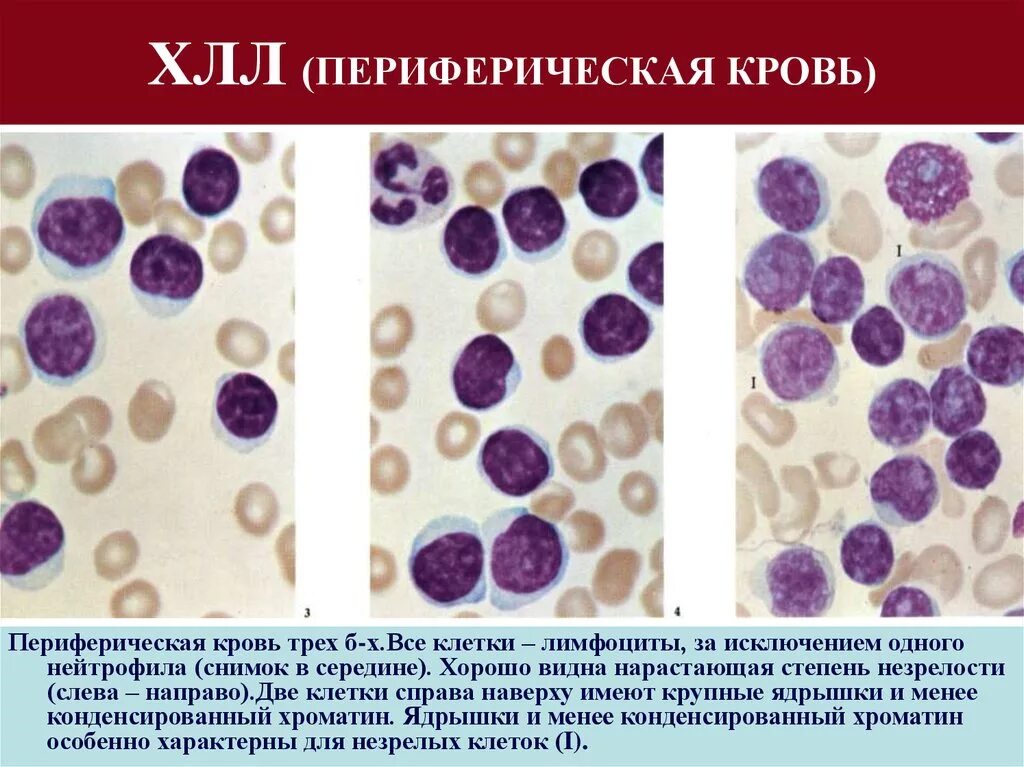 B хронический лимфолейкоз. Тени Боткина Гумпрехта. Острый лейкоз и хронический лимфолейкоз. Клетки Боткина Гумпрехта это. В -лимфоциты хронический лимфолейкоз.