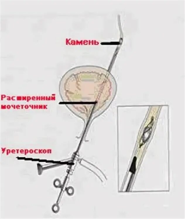 Стенд катетер для мочеточника. Камень в мочеточнике стент. Извлечение стента из мочеточника. Стенд для расширения мочеточника. Снятии стента