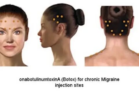 Ботулинотерапия при мигрени