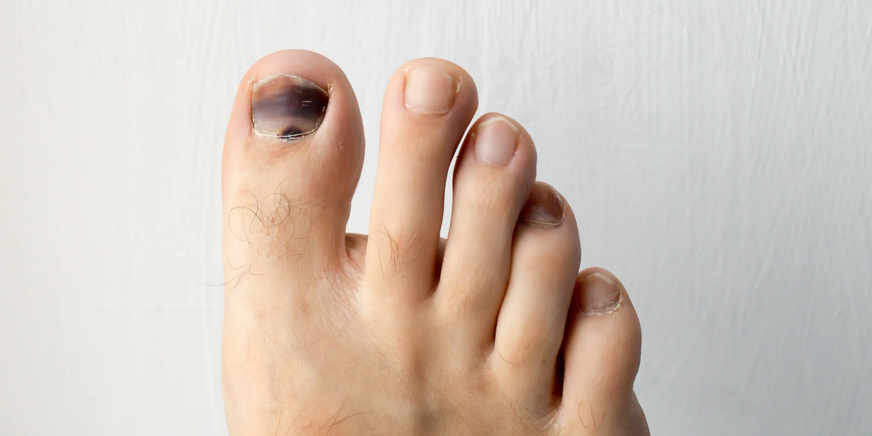 Стопа без большого пальца. Hallux valgus 1 плюснефалангового сустава. Вальгус косточка на большом пальце. Ноги без педикюра. Большой палец на ноге без нокты.