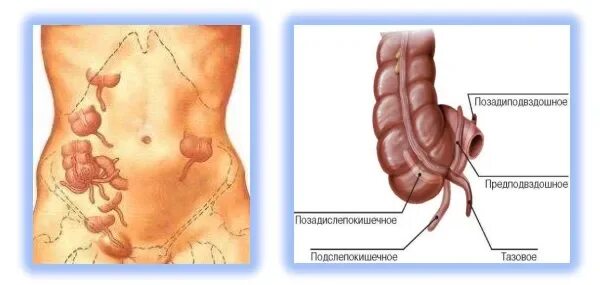 Размер аппендикса. Аппендикс это отросток слепой кишки. Слепая кишка с аппендиксом. Острый аппендицит клиника. Слепая кишка и червеобразный отросток.