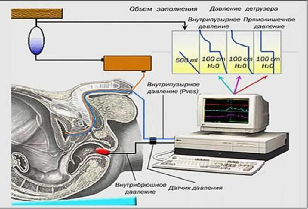 Цистометрия. Цистометрия наполнения. Ретроградная цистометрия. Цистометрия урология.