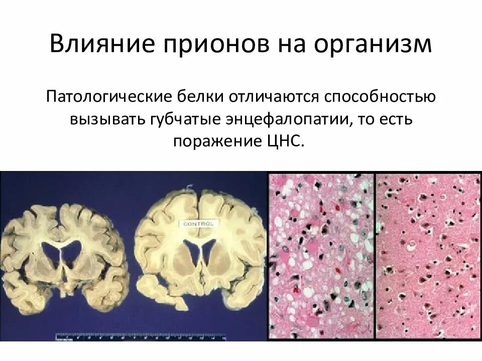 Прионы губчатая энцефалопатия. Прионные болезни энцефалопатии. Прион губчатая энцефалопатия КРС. Прионные болезни патогенез. Хтэ болезнь