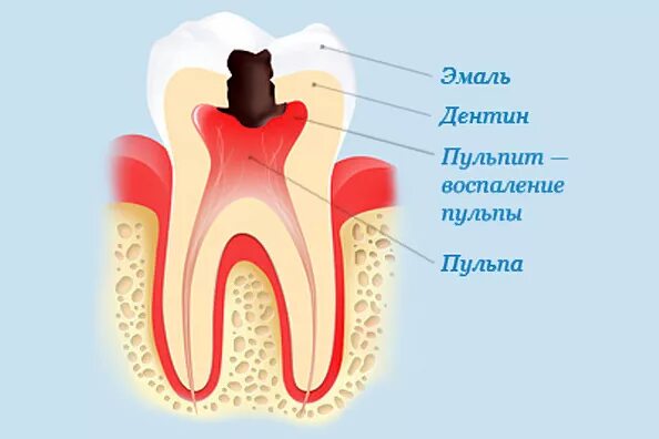 Сильная боль в зубе