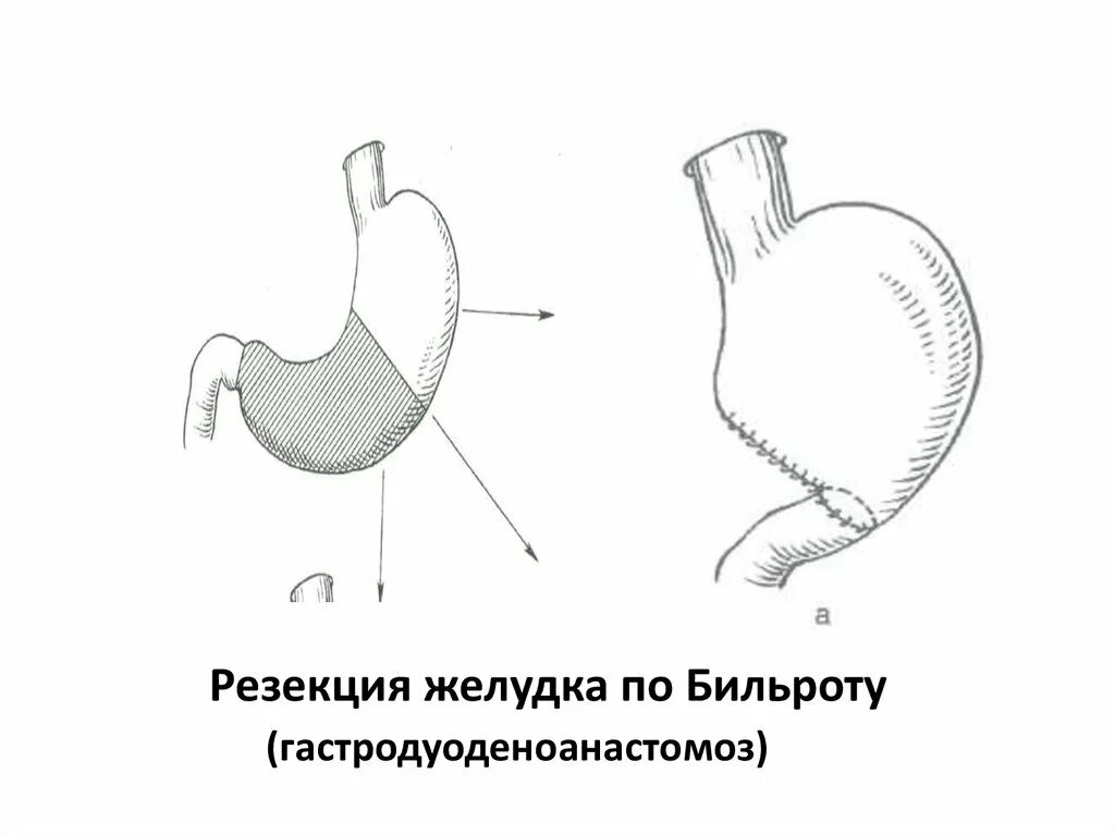 Осложнения после резекции желудка по Бильрот 1. Продольная резекция желудка схема. Резекция желудка по Бильрот 2.