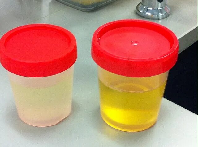 Chronic Renal Insufficiency Nephrotic syndrome, Nephropathy, Urinal