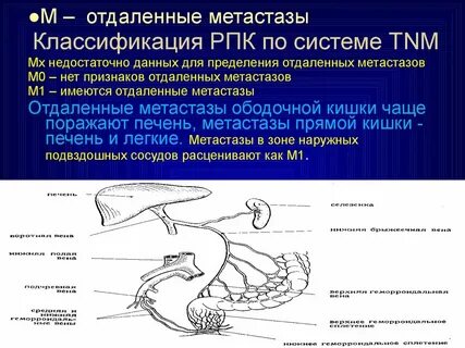 Рак сигмовидной прогноз